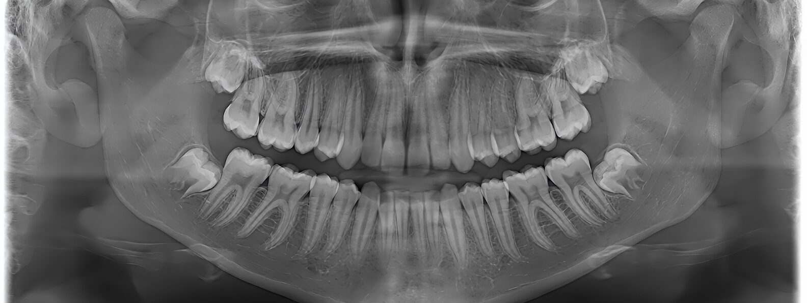 Dental Surgery in Irradiated Bone